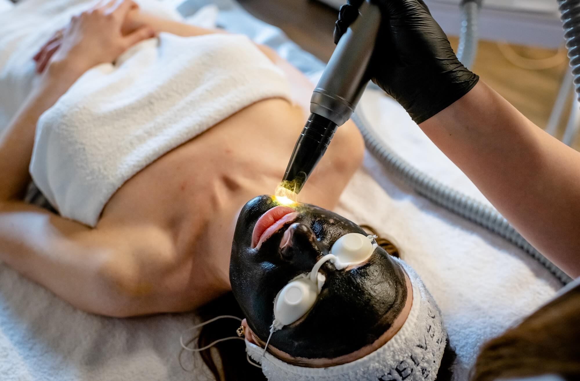 Carbon Peel